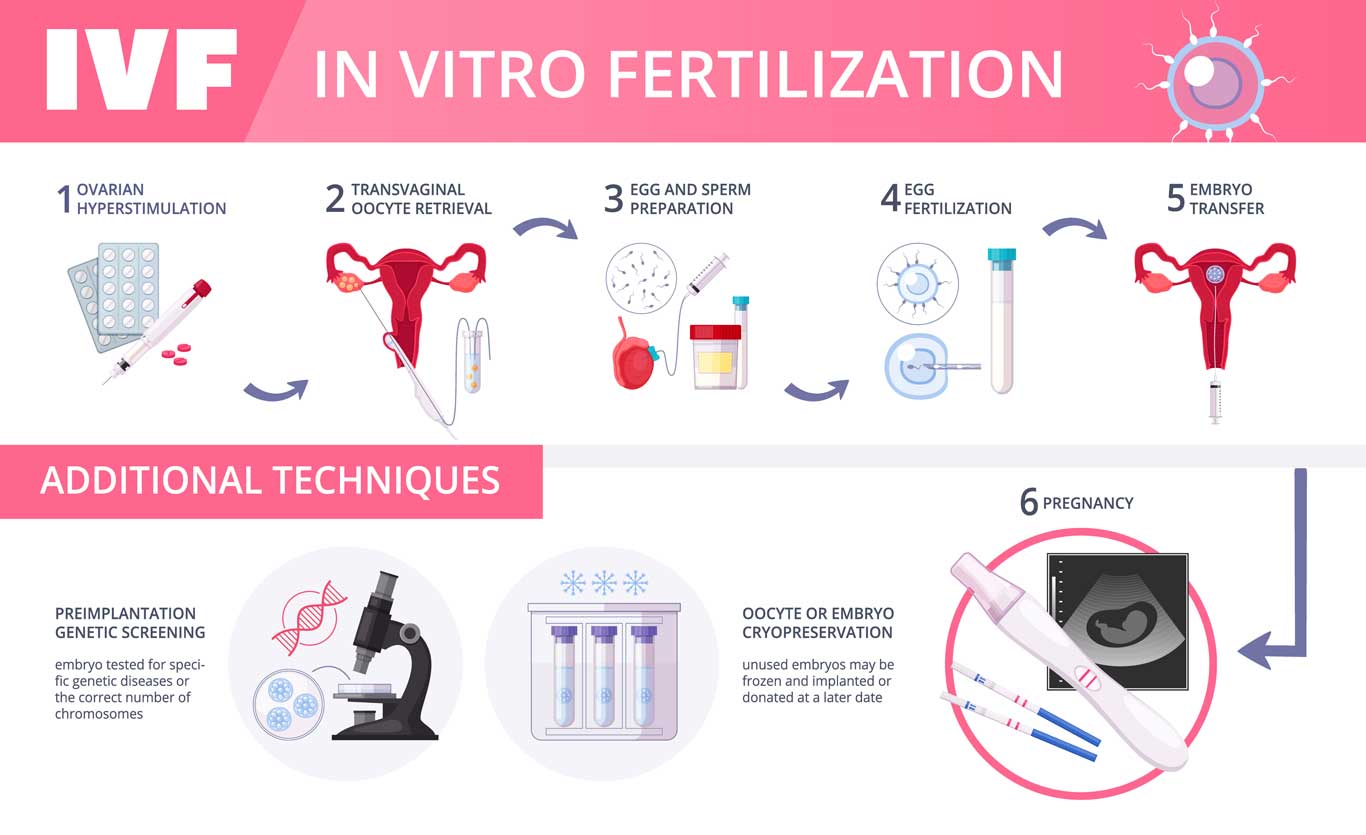 In Vitro Fertilization Steps